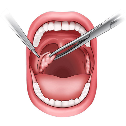 tonsillitis treatment